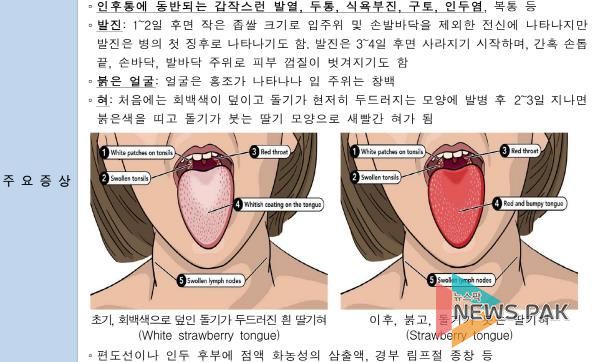 오산시, 성홍열 환자 증가에 따른 시민 주의 당부